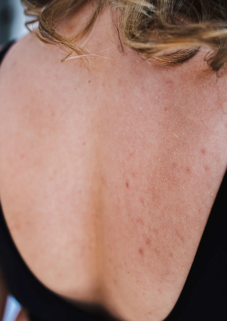 Acne op het lichaam