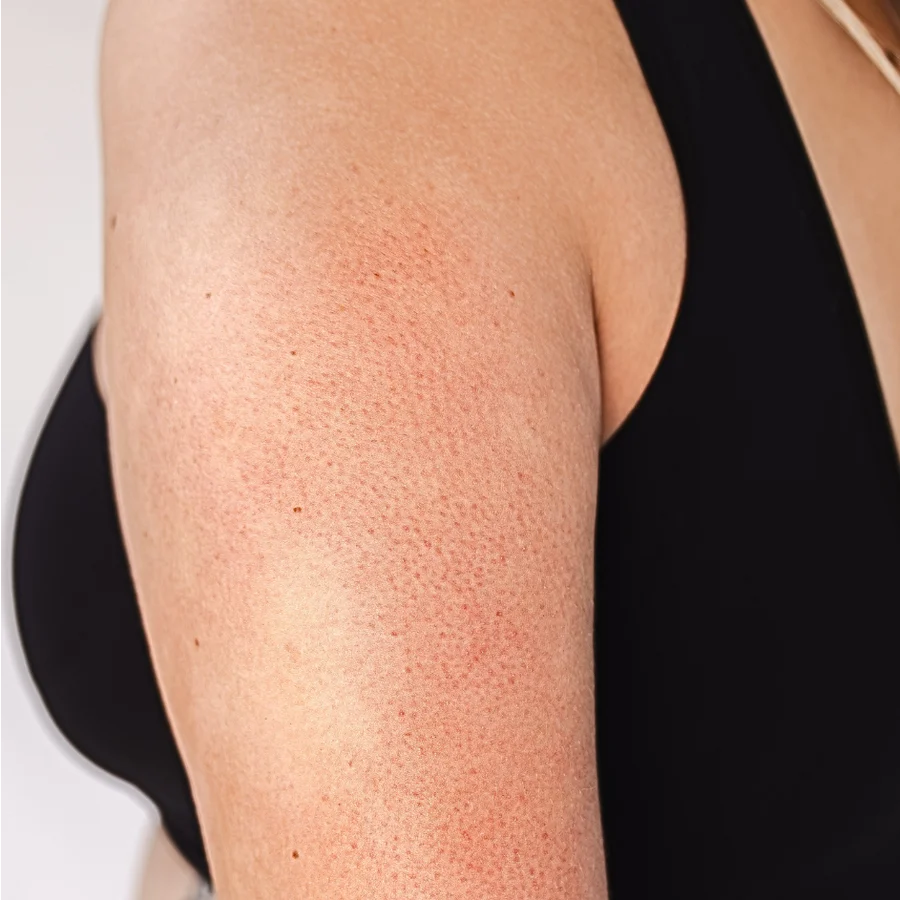 Keratosis pilaris